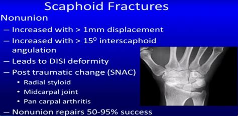 schaphoid compression test evidence|scaphoid fracture complications.